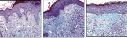 Recovery of acne scars in time through an increased collagen fibers