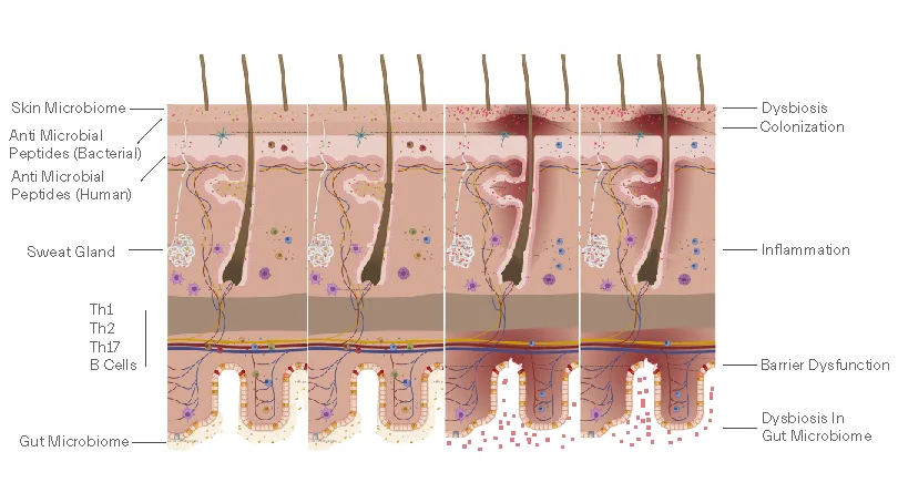 dysbiosis in acne treatment
