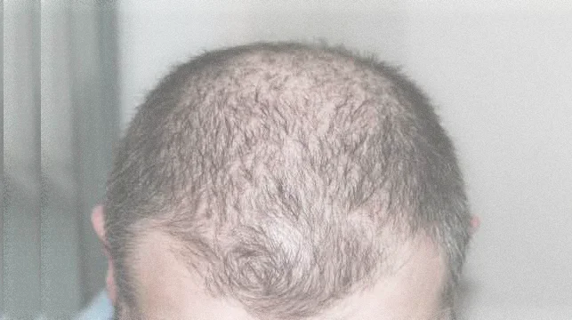 hair loss treatment for alopecia areata disease