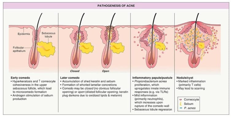 comedone progess into a cyst