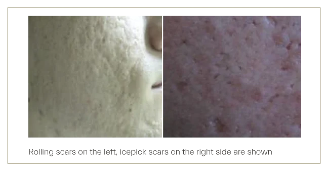 Acne scars may be clinically manifested in two prominent forms, icepick and rolling scars.  Acne scars treatment kit has been proven as a very effective viable option for treatment of icepick and rolling scars