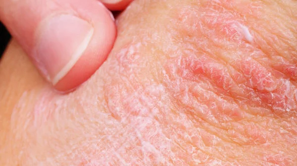 skin care treatment for atopic dermatitis disease