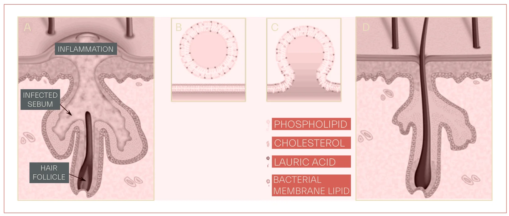 Sebaceous fatty acids in treatment of acne
