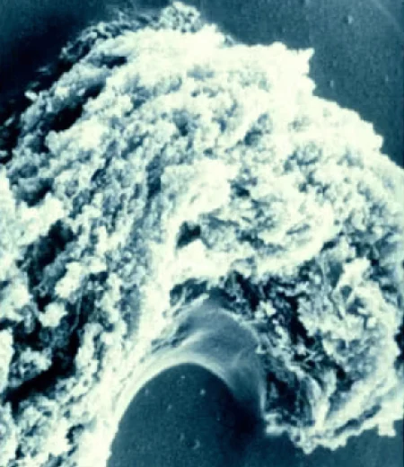 Microscopy of a comedone, an early stage of acne development