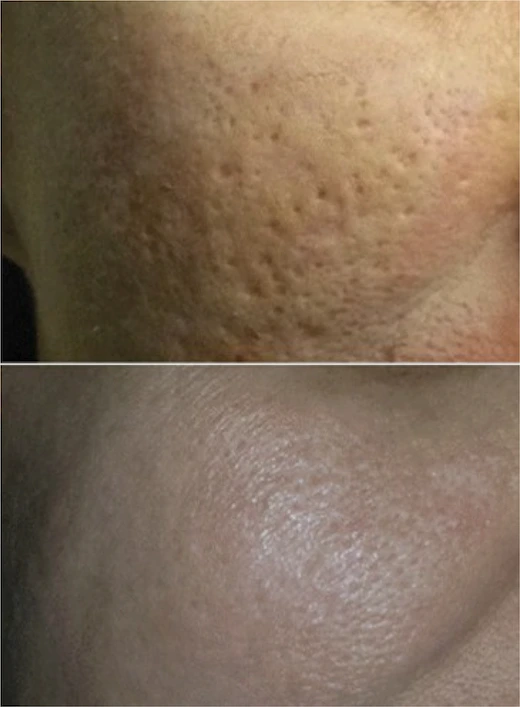 Acne scars treated with dermabrasion and chemcial peels