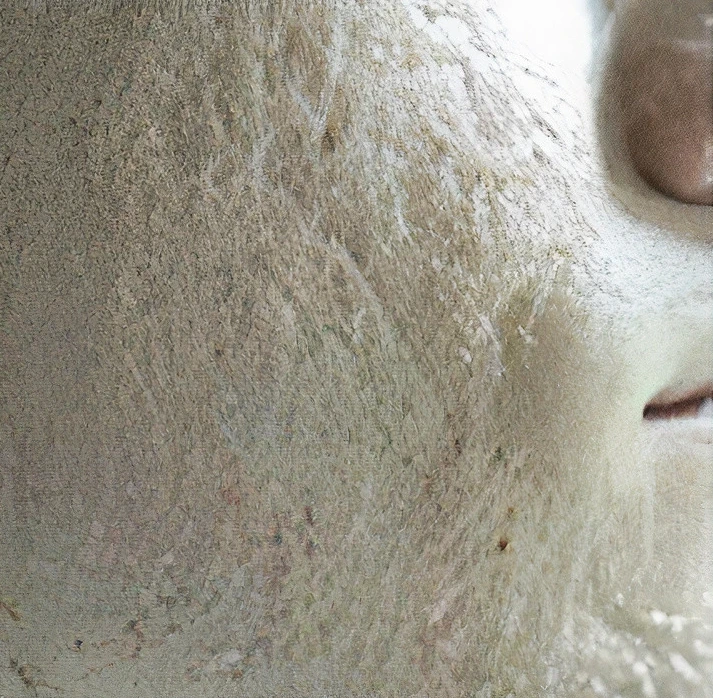 Acne scars of rolling type