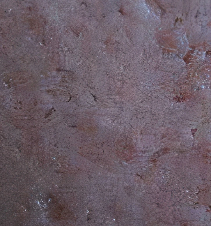 Acne scars, a combination of icepick and boxcar scarring