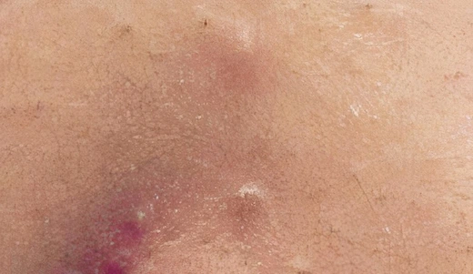 Comdedonal acne