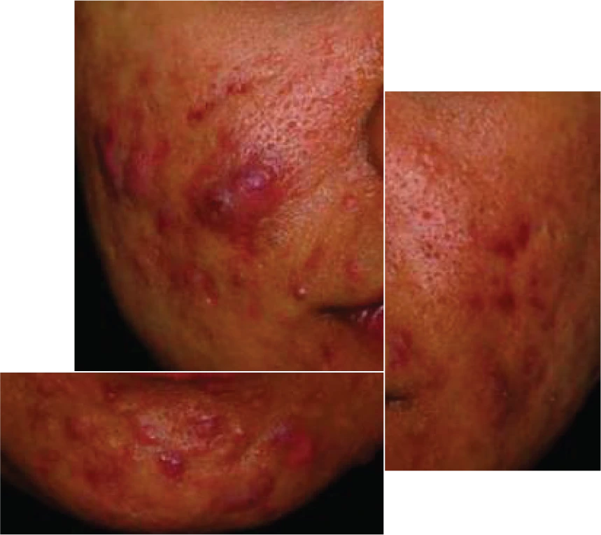 Nodulo cystic acne treatment options