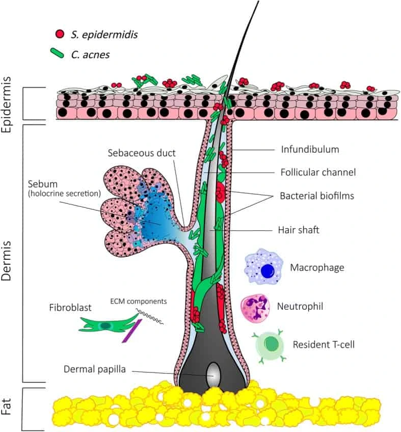 C. acnes and S. epidermidis commensal organsims topology in and around sebaceous gland and where antibacterial such as benzoyl peroxide for acne may target