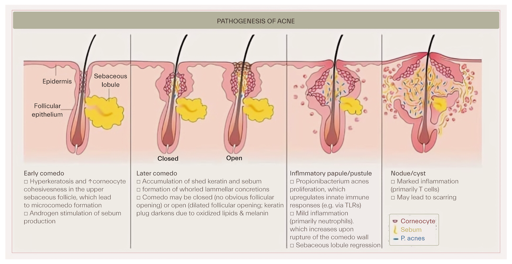 Stages of acne vulgaris progression from a comedo to a cyst