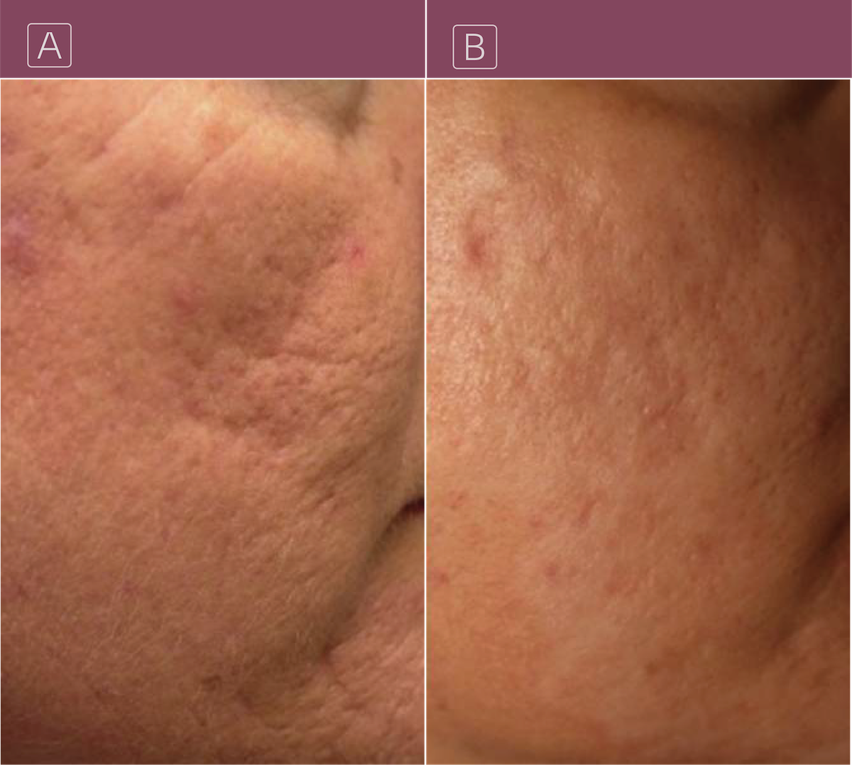 Aged acne scars before and after treatment