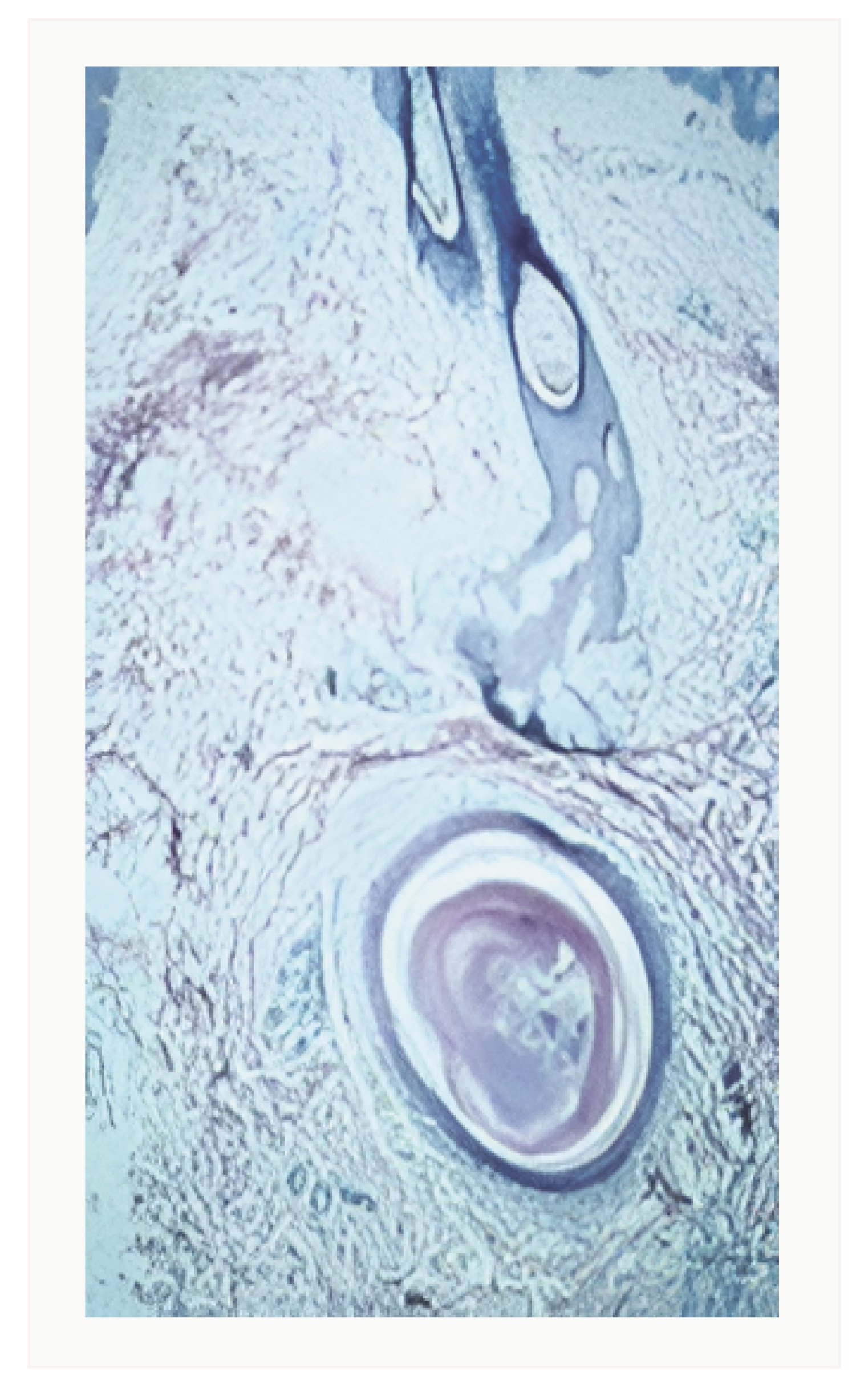 A comedone, an initial phase in acne pathogenesis affected by changes in sebum production