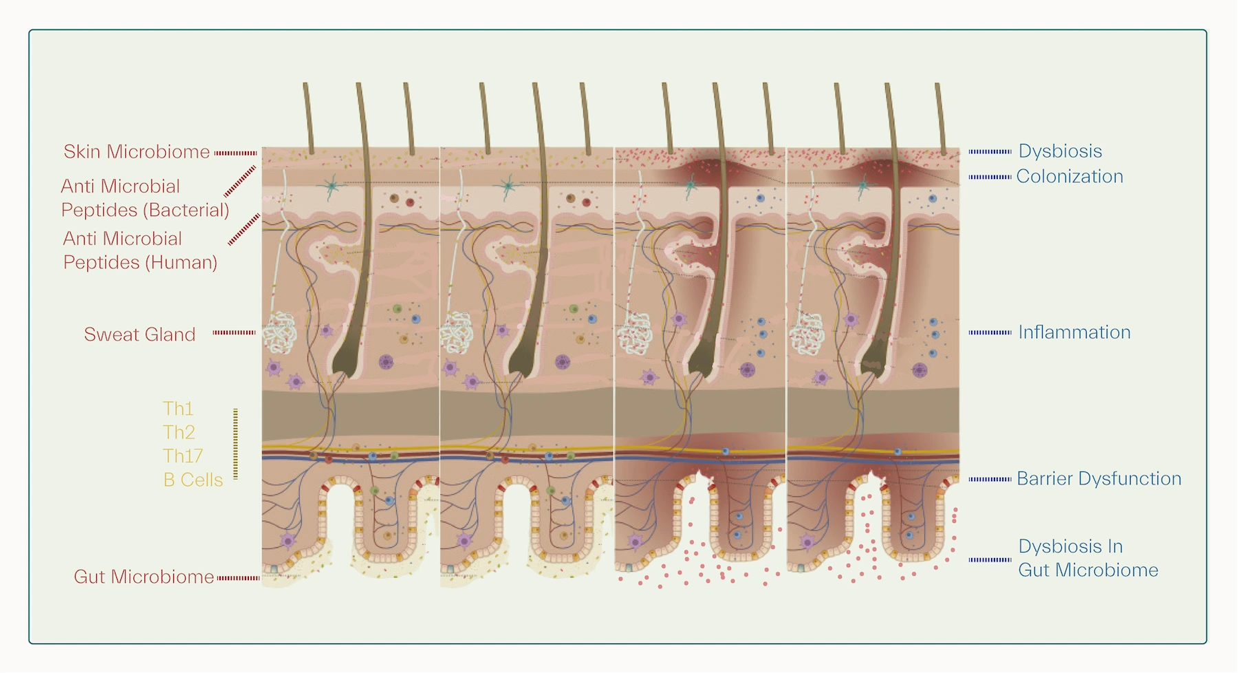dysbiosis in acne treatment