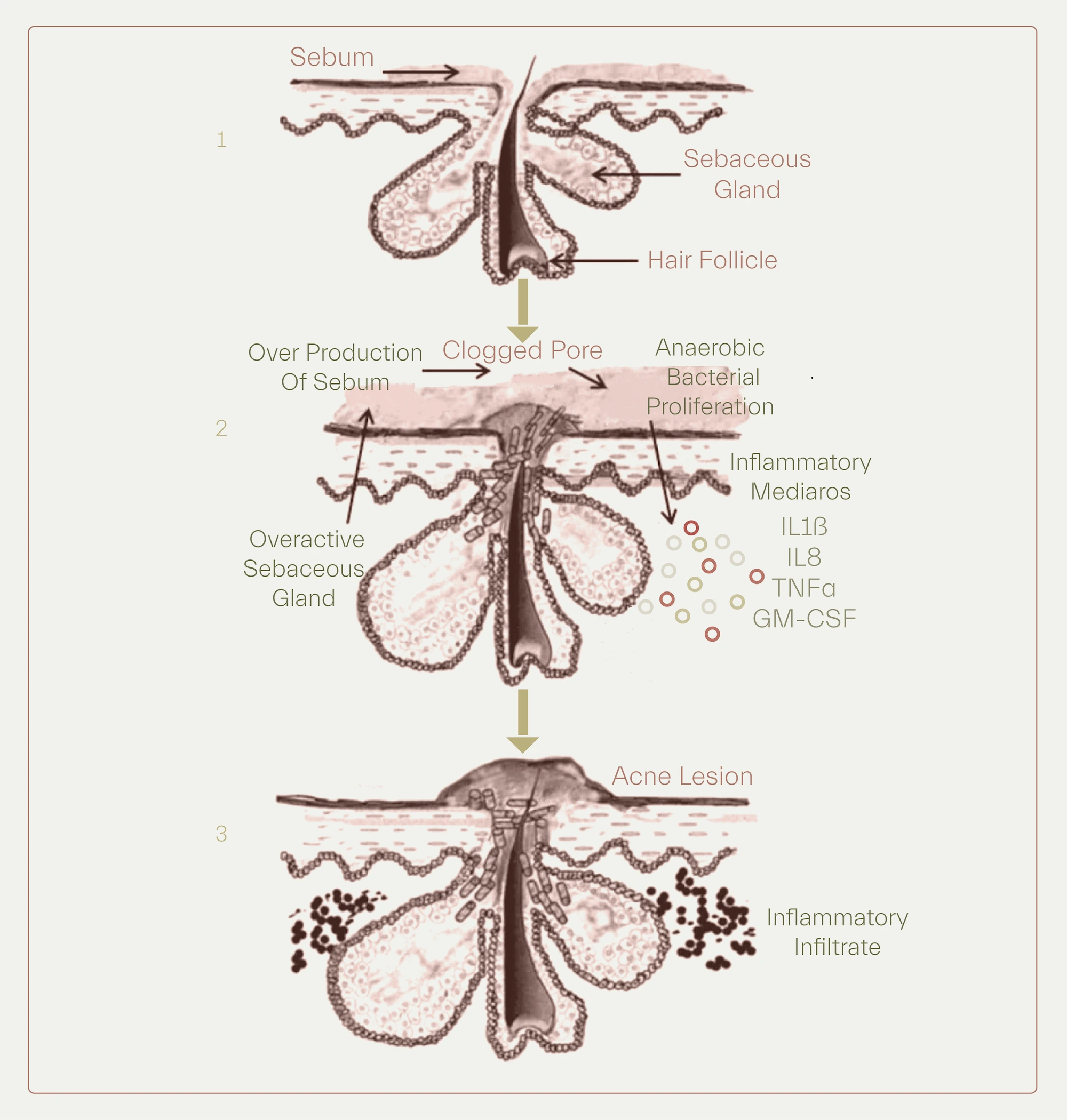 - Acne in development, inflammatory factors to address in treatment