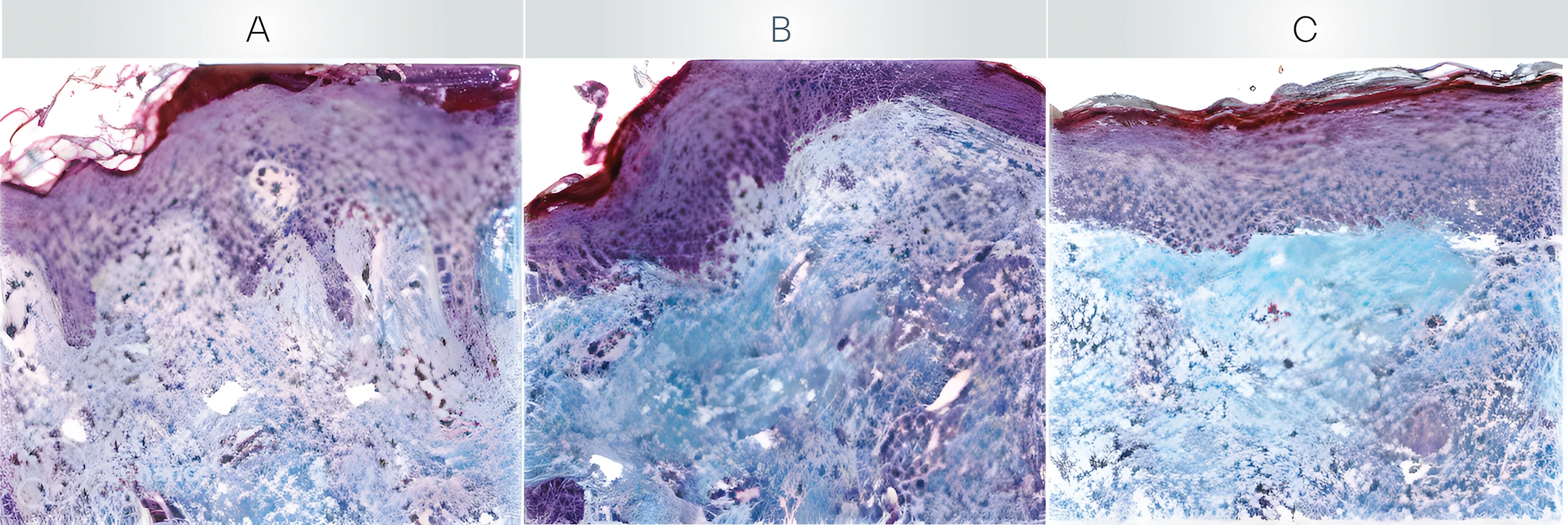 - Lipid peroxidation precipitates inflammation