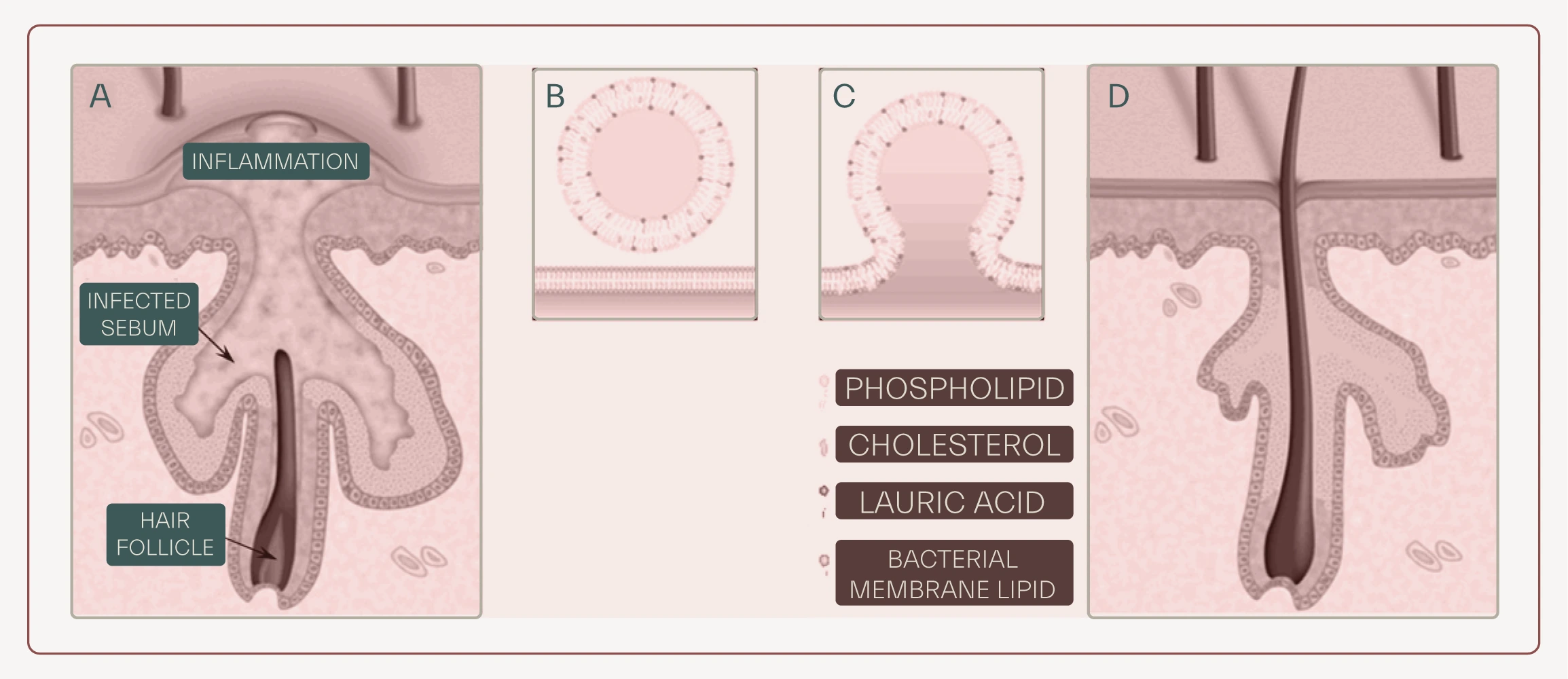 - Sebaceous fatty acids in treatment of acne