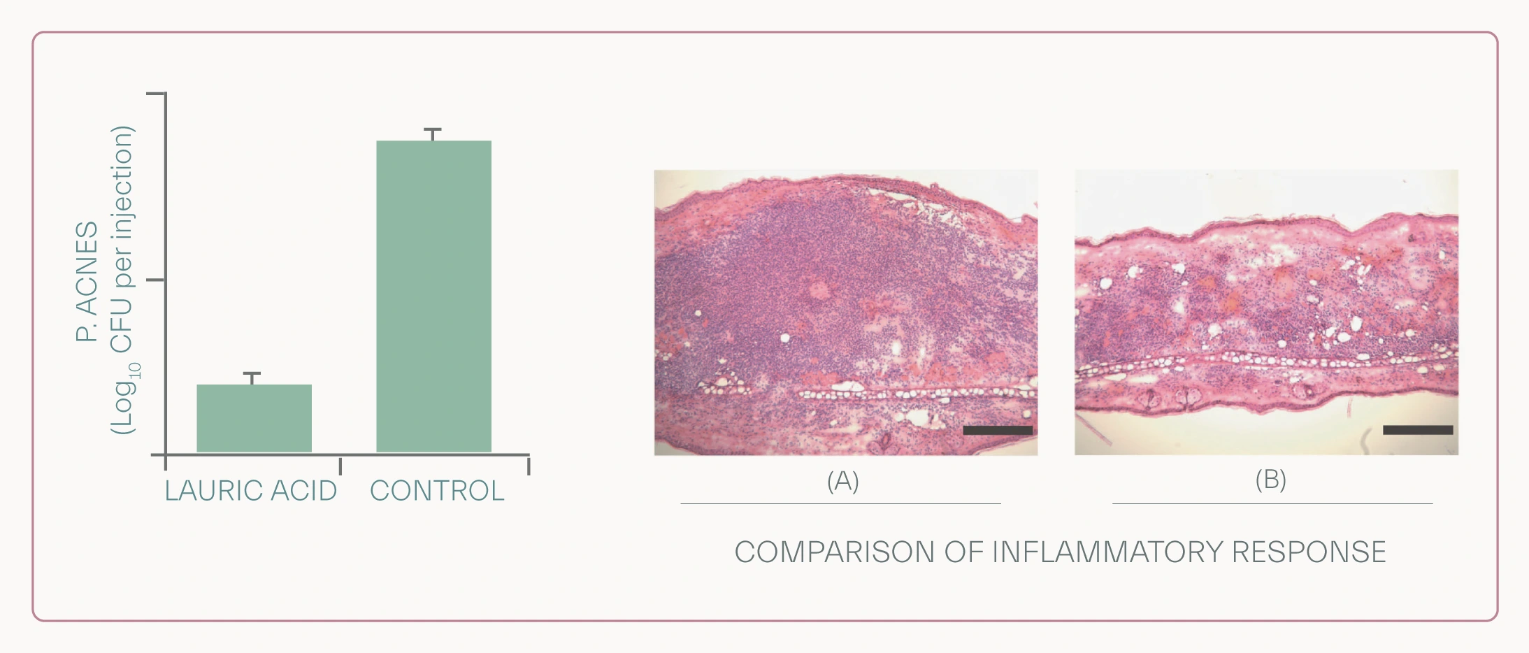 - Sebaceous fatty acids in treatment of acne